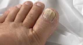 How to avoid fungal infections during the monsoons