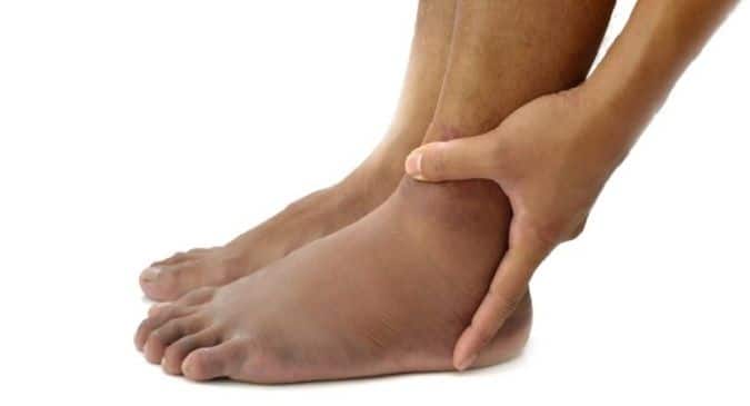 swollen heels of feet