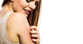 Home remedies for eczema : एक्जिमा से हैं परेशान तो अपनाएं ये घरेलू उपाय