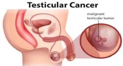 Study identifies autoimmune disease linked to testicular cancer