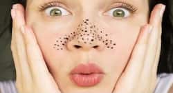These home remedies will make your blackheads vanish