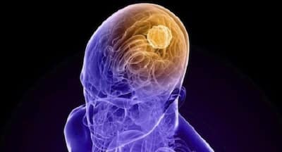 brain cancer -Glioblastoma - progression - treatment | TheHealthSite.com