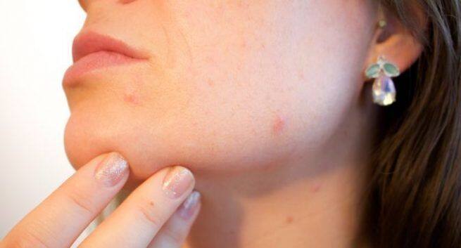 How To Get Rid of acne Easy remedies to get rid of pimples in Hindi