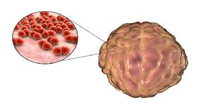 Pneumococcal meningitis: Know the risk factors to keep it at bay