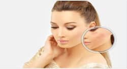 Acne scars: 5 natural removes that can get rid of it