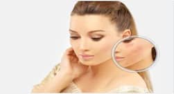 Acne scars: 5 natural removes that can get rid of it