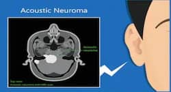 Acoustic Neuroma : ध्वनिक न्यूरोमा के लिए ''साइबरनाइफ'' एक वरदान