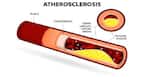 Study raises hope of new atherosclerosis treatment: Know all about this condition