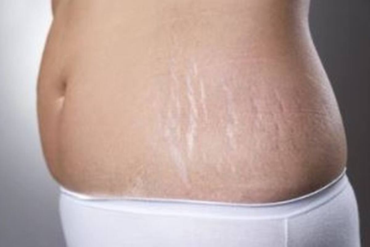 5 Ways To Reduce Stretch Marks During And After Pregnancy Thehealthsite Com