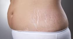 प्रेगनेंसी मार्क्स या स्ट्रेच मार्क्स दूर करते हैं ये खास विटामिन