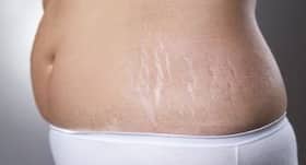 Follow this two-step skincare routine to combat pregnancy stretch marks Follow this two-step skincare routine to combat pregnancy stretch marks