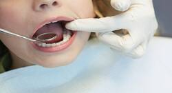 Teeth-whitening procedure: 5 common myths busted