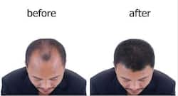Hair Transplant Precautions : हेयर ट्रांसप्लांट करवाने से पहले, ये बातें भी जरूर जान लें