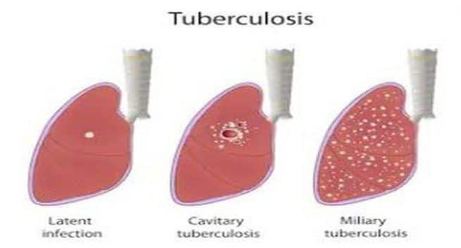 World Tuberculosis Day Tests To Determine If You Have Tb Or Not