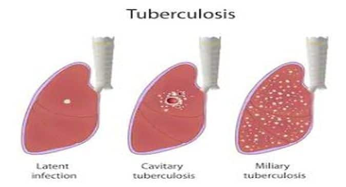 World Tuberculosis Day 2020: Tests to determine if you have TB or not ...