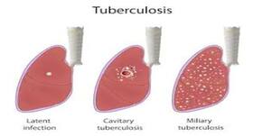World Tuberculosis Day 2020: TB tests you need to know about