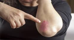 4 common myths about psoriasis busted