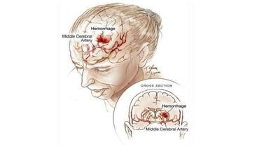 Older patients - silent strokes - cognitive decline - brain stroke ...