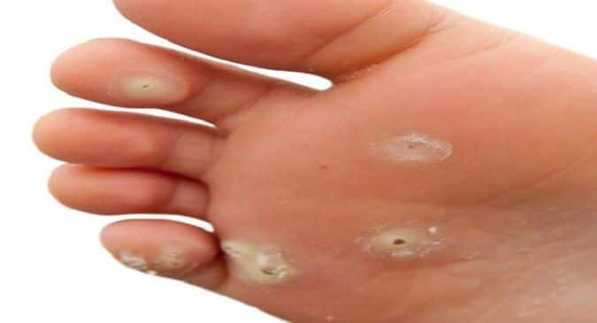 Are Warts Worrying You Duct Tape Wart Solution Human Papillomavirus Thehealthsite Com