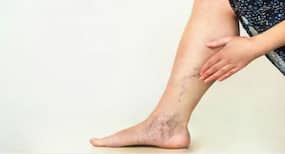 Varicose Veins : गंभीर जटिलताओं से बचने के लिए समय पर कराएं ''वेरिकोज वेन्स'' का इलाज, जानें इसका उपचार