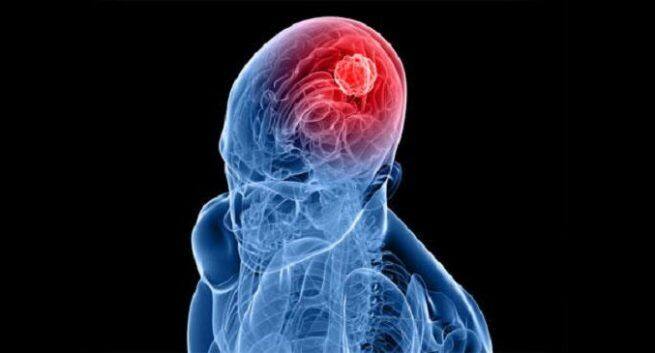 Leukemia drug Treatment of brain cancer in children