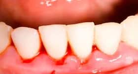 Fillings may not be the best way to tackle tooth decay in children : Study Fillings may not be the best way to tackle tooth decay in children : Study
