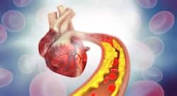 Cholesterol Level : कोलेस्ट्रॉल लेवल कंट्रोल करने के लिए अपनाएं ये आयुर्वेदिक उपाय