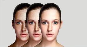 Skin Pigmentation : जाने क्या है पिगमेंटेशन, इसके प्रकार, कारण और बचने के तरीके