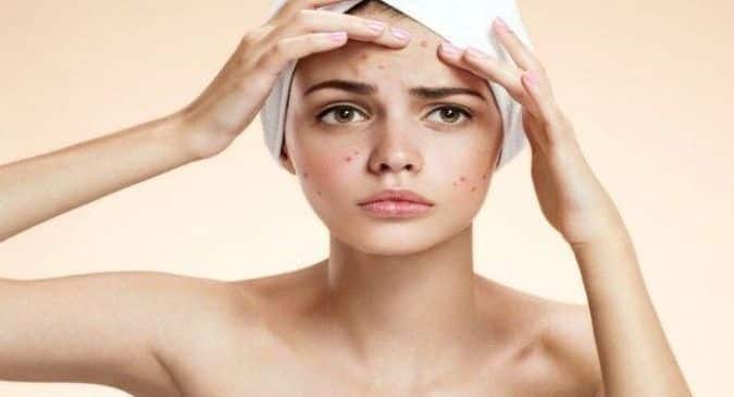 Some people get more acne in winter: Here’s why