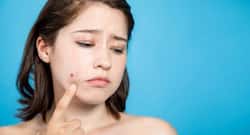 Pimple Problem: नहीं ठीक हो रही है पिम्पल्स की प्रॉब्लम, आपकी डायट हो सकती है वजह!