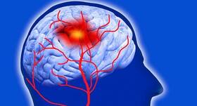 World Stroke Day: जानें क्यों खून के थक्के बनना या ब्लड क्लॉटिंग है खतरनाक, बढ़ सकता है स्ट्रोक का खतरा