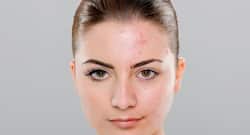Adult acne: They trouble women more than men