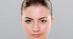 Adult acne: They trouble women more than men Adult acne: They trouble women more than men