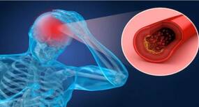 World Stroke Day 2019 : मोटे लोगों को होता है स्ट्रोक का खतरा अधिक, जानें स्ट्रोक के अन्य कारण क्या हैं
