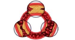 5 foods that can naturally prevent arteries from clogging