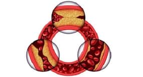 Fat around arteries is actually good for your health: Study