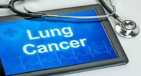 Four surprising signs of lung cancer, and when you should get them checked out