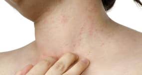 Dermatitis – types, causes, symptoms, treatments, complications, prevention