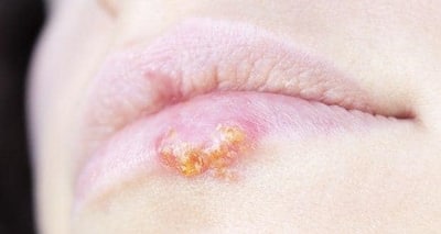 6 common signs and symptoms of herpes | TheHealthSite.com