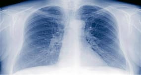 India doesn't have 63000 drug-resistant TB cases, RNTCP challenges WHO