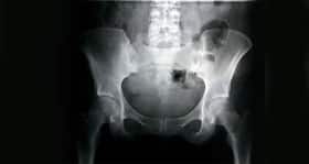 New drug can help avoid hip surgeries for avascular necrosis (AVN)