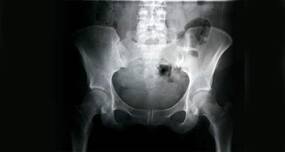 New drug can help avoid hip surgeries for avascular necrosis (AVN)