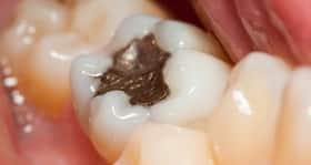 Amalgam - the silver dental filling material Amalgam - the silver dental filling material