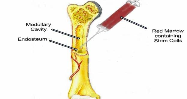 Side effects of bone marrow transplant