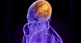 New non-invasive procedure that inhibits brain tumour growth