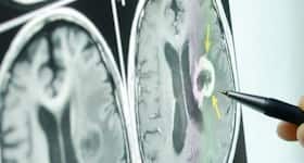 'Golden hour' awareness can prevent strokes: Experts 'Golden hour' awareness can prevent strokes: Experts