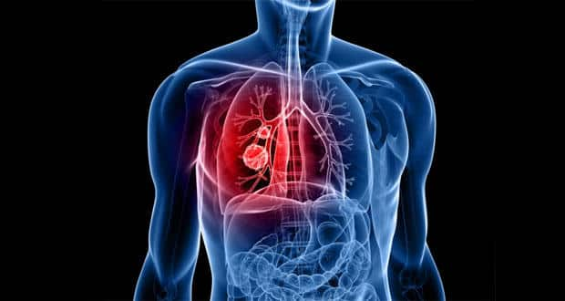 Discovered -- the gene that spreads lung cancer | TheHealthSite.com