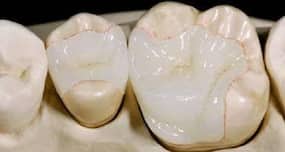 Ceramic  - the natural tooth mimicking dental filling material