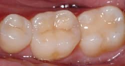 Composite resin - the white dental filling material