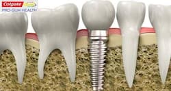 Dental Implants: Procedure, precautions, cost, risks